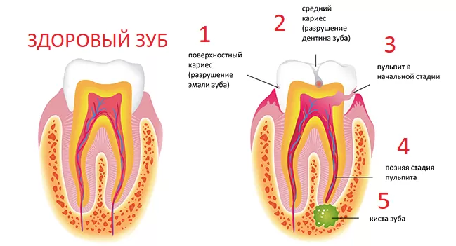 Причины развития кисты и гранулемы зуба